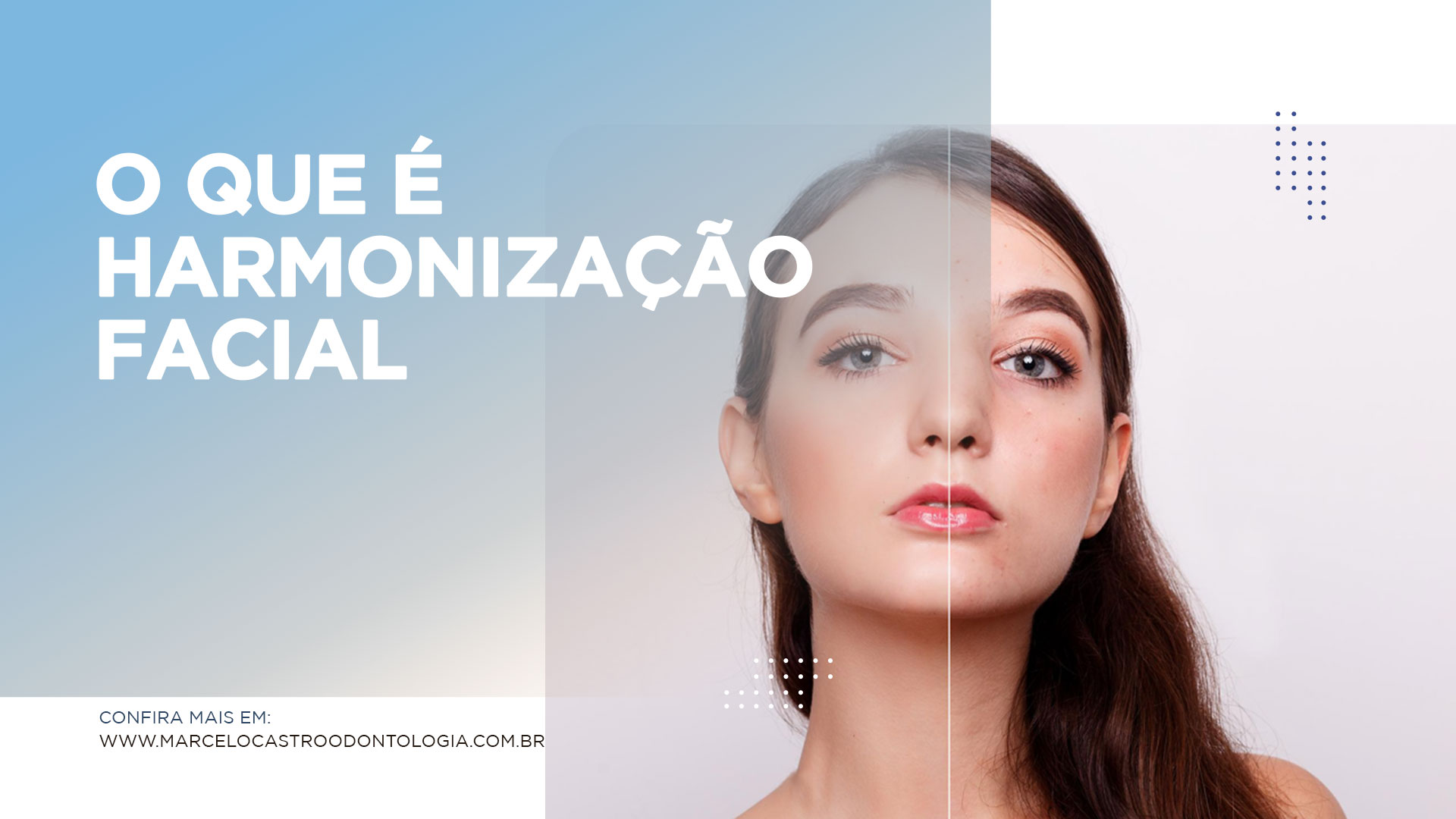 Thumbnail-Harmonização-Facial