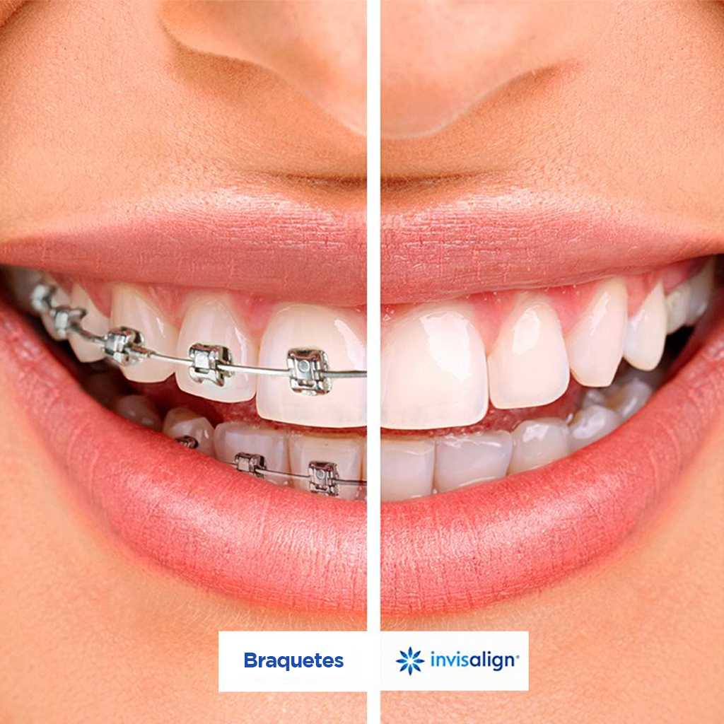Braquetes-x-invisalign