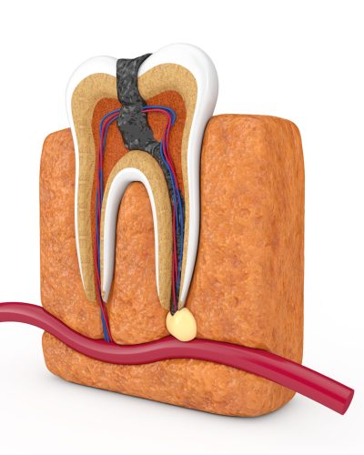 Endo Tratamento de Canal